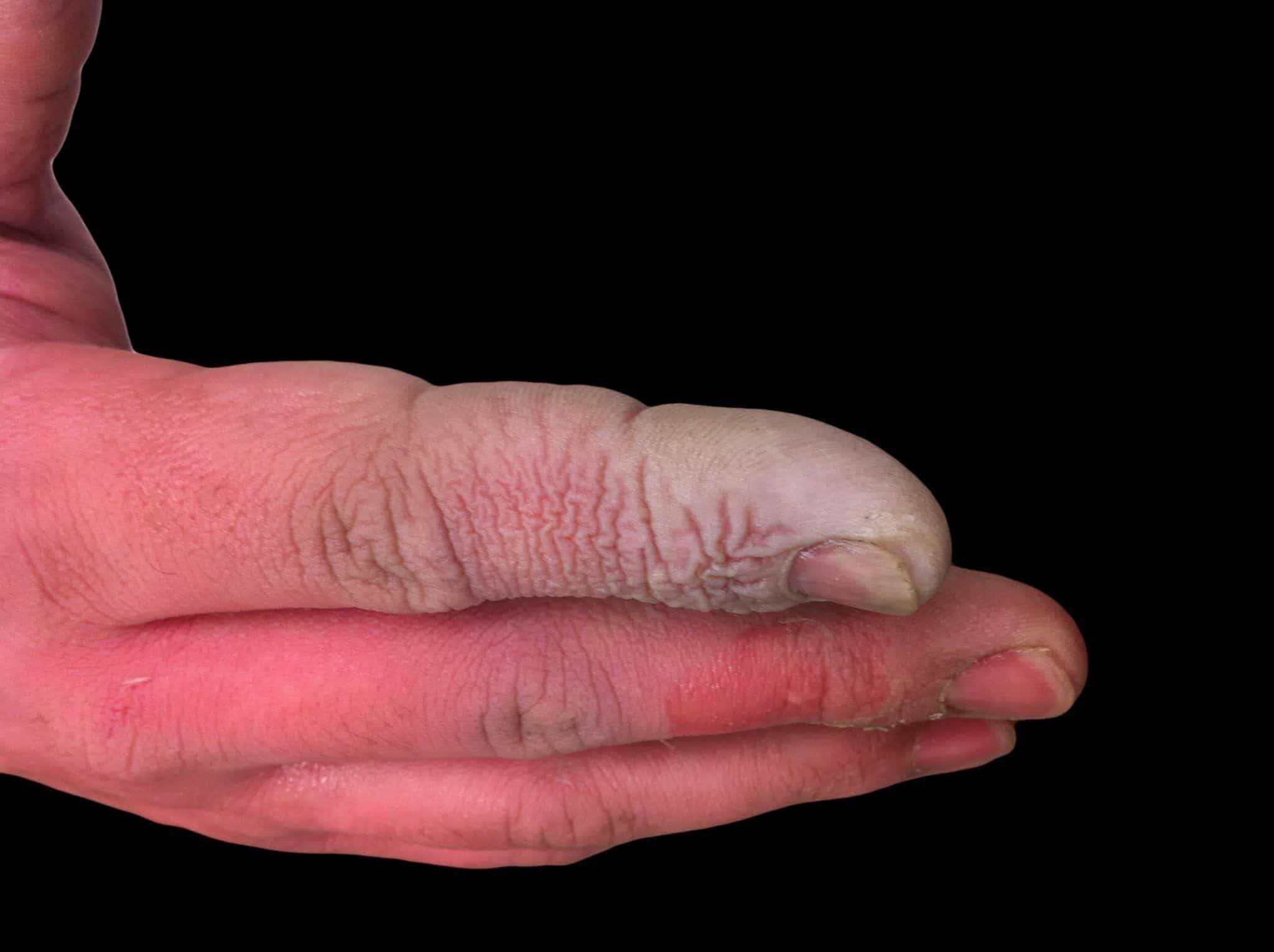 First Aid for Chemical Burns – Lexicon